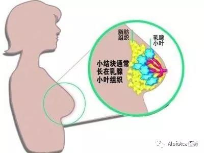 关爱女性健康，预防乳腺疾病